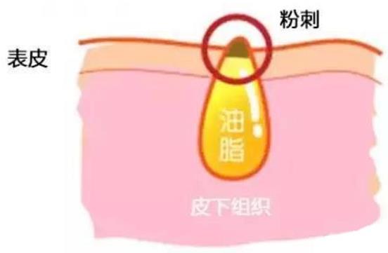 甲硝唑凝膠去黑頭要看主流，別拿個(gè)體差異混淆視聽