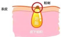甲硝唑凝膠去黑頭要看主流，別拿個(gè)體差異混淆視聽(tīng)
