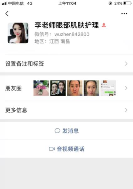幻柔筆記：眼袋修復(fù)后氣質(zhì)立現(xiàn)，怎么看都是青春靚麗！