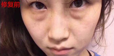 幻柔筆記：眼袋修復(fù)后氣質(zhì)立現(xiàn)，怎么看都是青春靚麗！