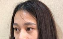 君雅筆記：眼袋過重，就會顯得比真實年齡大，要如何修復(fù)眼袋呢？
