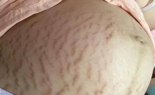 肥胖紋是愛(ài)美女士心里的痛 肥胖紋該怎么做才能去除