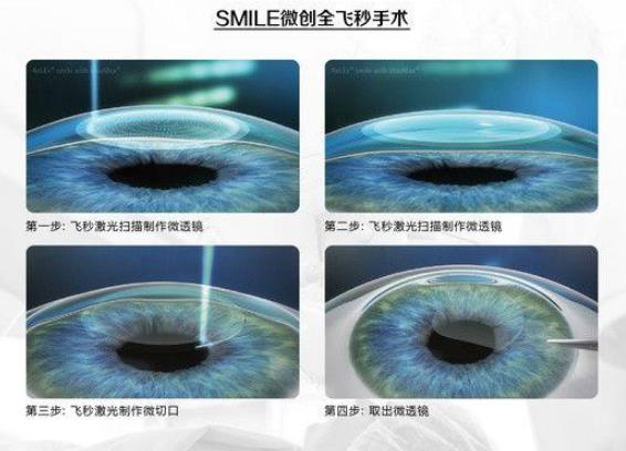 西安普瑞眼科醫(yī)院好嗎？戴眼鏡VS近視手術，四個對比讓你不糾結