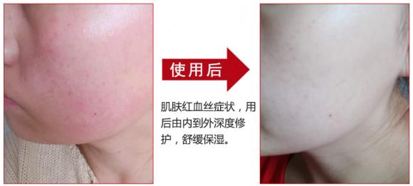 放心！有美薏升修復(fù)敏感肌紅血絲專家產(chǎn)品在，你每天都可以美美噠