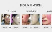 放心！有美薏升修復(fù)敏感肌紅血絲專(zhuān)家產(chǎn)品在，你每天都可以美美噠