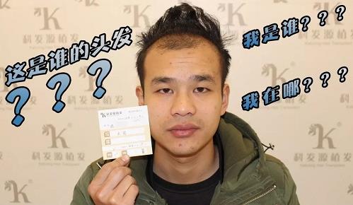青島大麥微針植發(fā)2500毛囊單位，術(shù)后8個(gè)月恢復(fù)頭發(fā)濃密